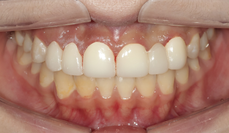 왜소치, 결손치가 동시에 있었던 환자의 앞니 심미보철 관련 이미지 10