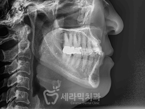 40대에 이어 50대 치아교정 전후사례 증가 추세 관련 이미지 16