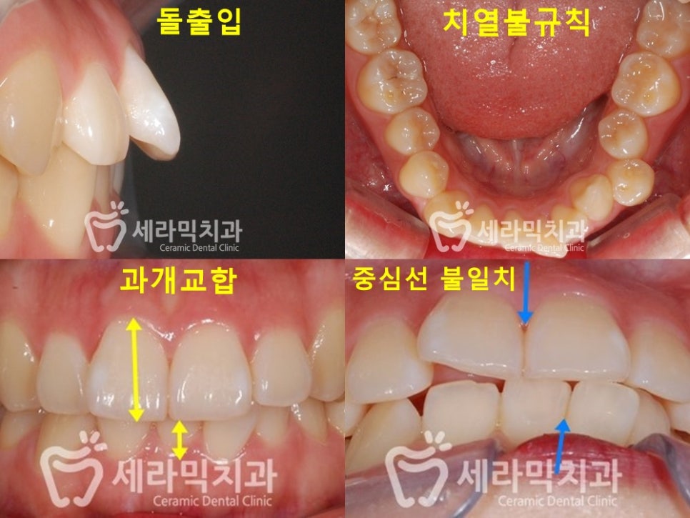 돌출입과 과개교합, 중심선 불일치, 치열불규칙 치아교정전후사진 관련 이미지 4