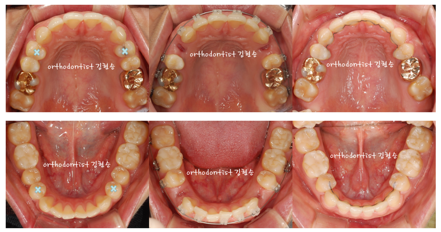 발치 돌출입교정으로 인상개선, 동안 만들기 관련 이미지 6