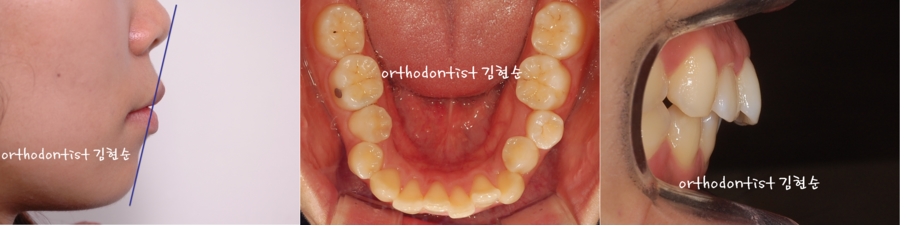세라믹교정 은 세라믹치과 돌출입발치 관련 이미지 3