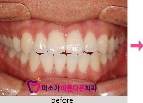세라믹치과 돌출입교정 관련 이미지 4