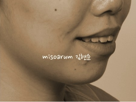 세라믹치과 돌출입교정 투명교정기로 ~ 관련 이미지 1