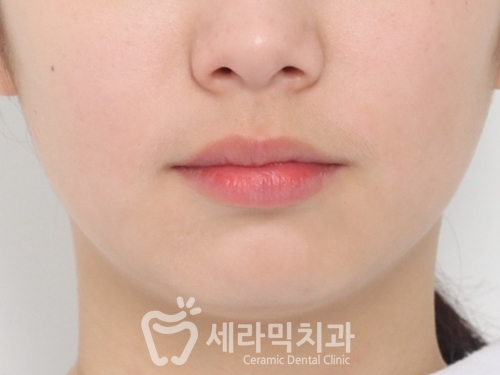 돌출입교정, 심미성과 치아 건강을 동시에 해결! 관련 이미지 5