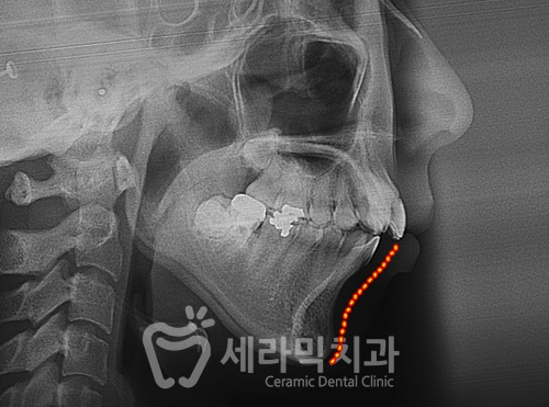 앞니 돌출, 개방교합으로 치아교정을 시작했는데, 작았던 아래턱이 커졌어요! 관련 이미지 4