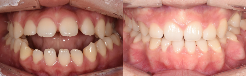 학동역 교정치과, 개방교합과 비대칭을 수술없이 교정한 경우 관련 이미지 11