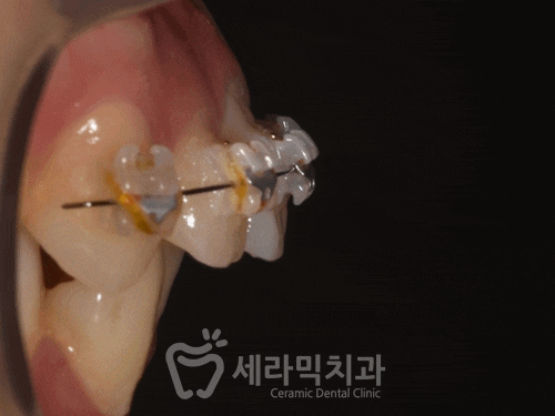 Before and After Orthodontic Treatment for Protruding Mouth and Deep Bite: A Calmer, More Sophisticated Transformation! image 10