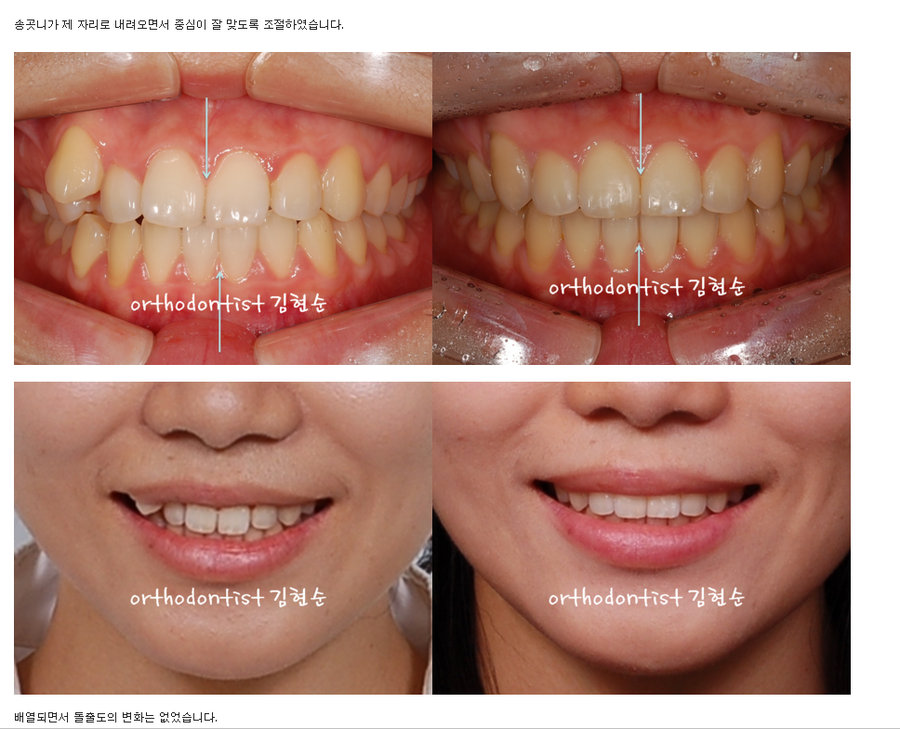 비발치로 덧니의 치열을 개선, 중심선을 맞추는 교정. 관련 이미지 5
