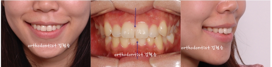 세라믹교정 은 세라믹치과 돌출입발치 관련 이미지 2