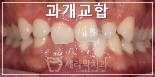 A Case of Overretained Teeth and Deep Bite Orthodontics That Helped the Patient Smile Confidently Before and After image 1