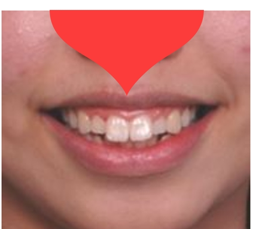 학동역 돌출입교정 세라믹치과 관련 이미지 7