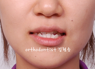 강남 덧니 관련 이미지 2