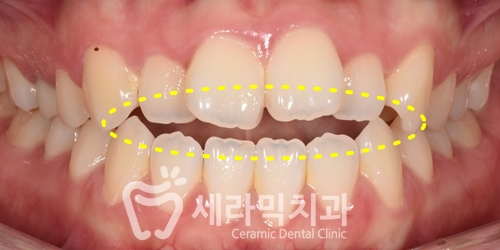 혀내밀기 습관과 개방교합, 오픈바이트(Open bite) 치아교정전후 보기 관련 이미지 3