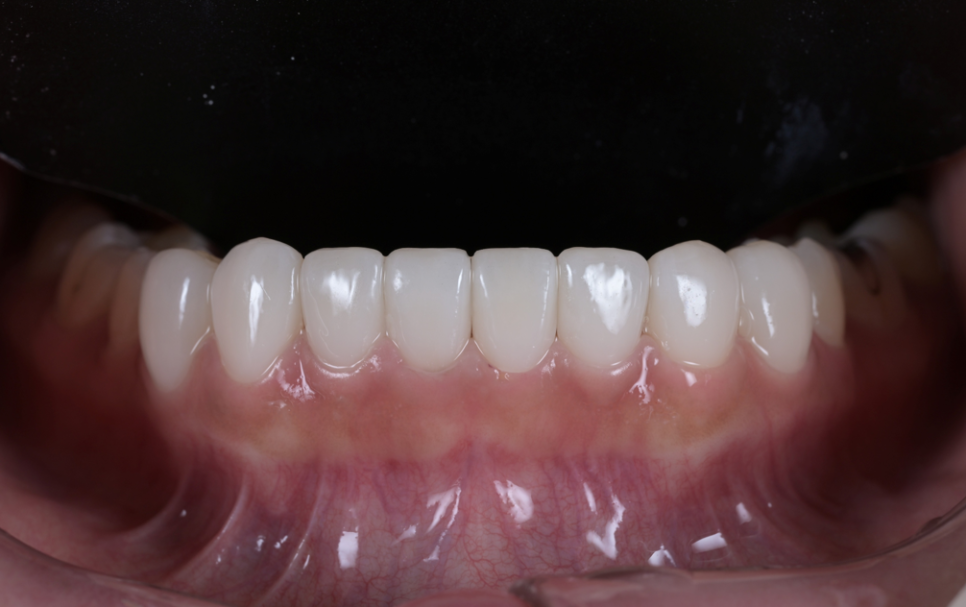앞니 벌어짐, 교정 없이 라미네이트로 해결한 경우 관련 이미지 6