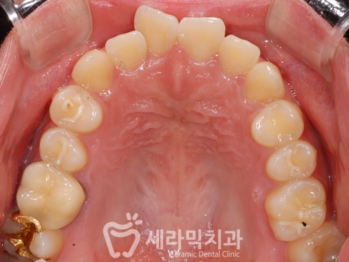 돌출입교정으로 갸름한 턱라인까지 되찾다! 돌출입 치아교정전후 관련 이미지 13