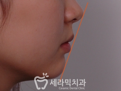 토끼이빨 돌출입 치아교정 전후 표정변화! 관련 이미지 7