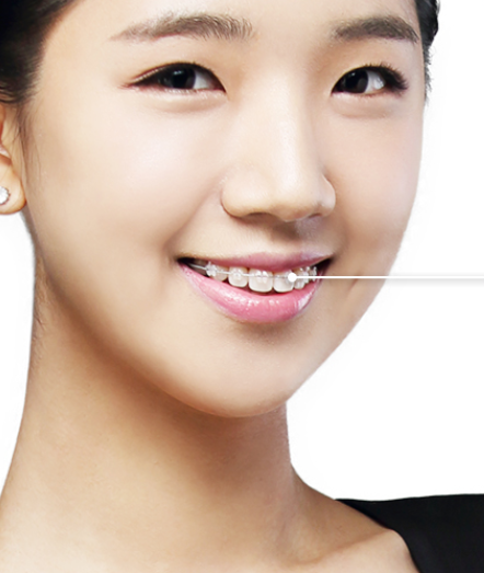 세라믹교정 3M  치아교정 모델 신청 ~ 관련 이미지 13