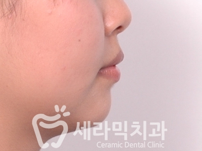 토끼이빨, 틀어진 치아배열 세라믹교정 전후사진 관련 이미지 10