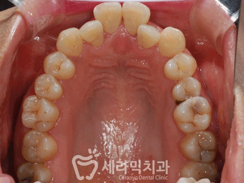 돌출입, 치열불규칙, 치아상실 치아교정과 임플란트 전후 관련 이미지 9