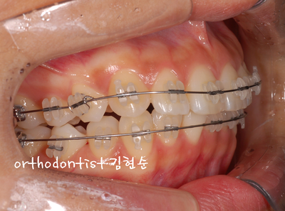 돌출 교정 (비발치 교정/비대칭) 관련 이미지 19