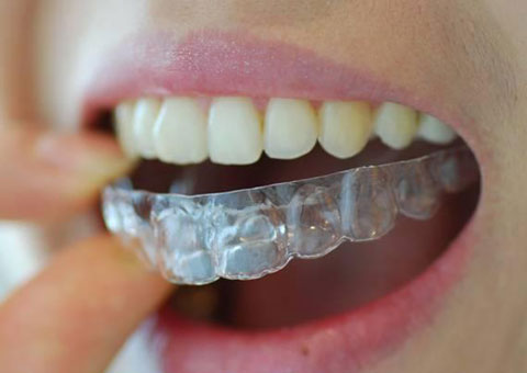 [ 학동역 교정치과 미소가아름다운치과 ] 부분교정 관련 이미지 1