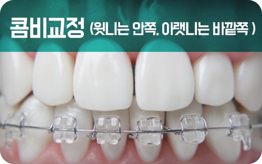 교정장치 구분하기 관련 이미지 16