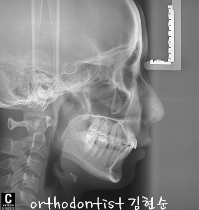 돌출 교정 (비발치 교정/비대칭) 관련 이미지 35