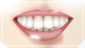 A Case of Overretained Teeth and Deep Bite Orthodontics That Helped the Patient Smile Confidently Before and After image 2