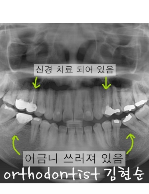 학동역치과 돌출입교정은 세라믹치과에서 관련 이미지 6