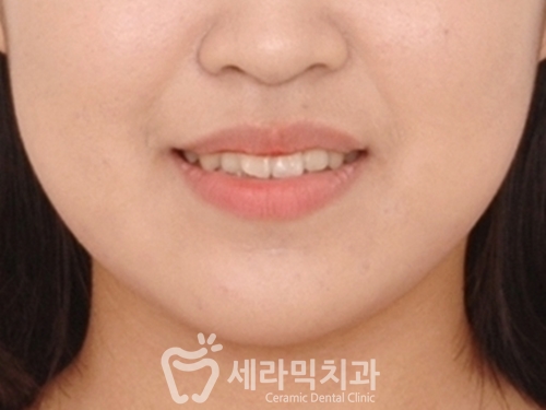 돌출입교정으로 갸름한 턱라인까지 되찾다! 돌출입 치아교정전후 관련 이미지 5