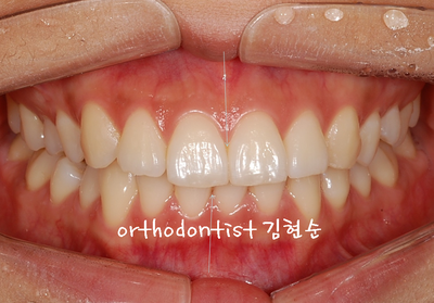 돌출 교정 (비발치 교정/비대칭) 관련 이미지 3