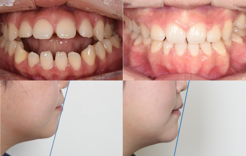 학동역 교정치과, 개방교합과 비대칭을 수술없이 교정한 경우 관련 이미지 1
