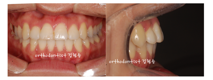 안면비대칭 교정, 치아교정만으로 간단히 해결하기 관련 이미지 13