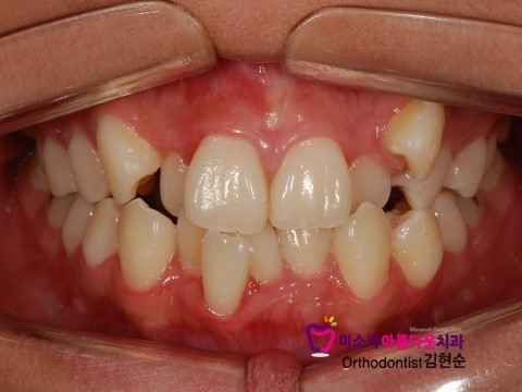 논현동교정잘하는치과에서 알려주는 교정과정! 고무줄 관련 이미지 3