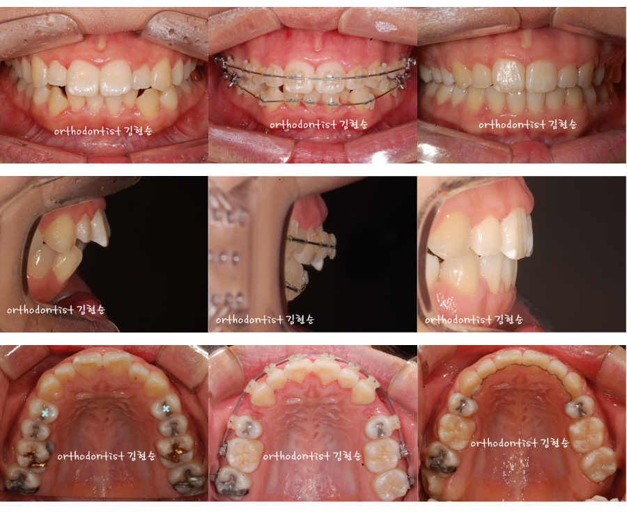세라믹교정 세라믹치과-돌출입발치교정 5 관련 이미지 3