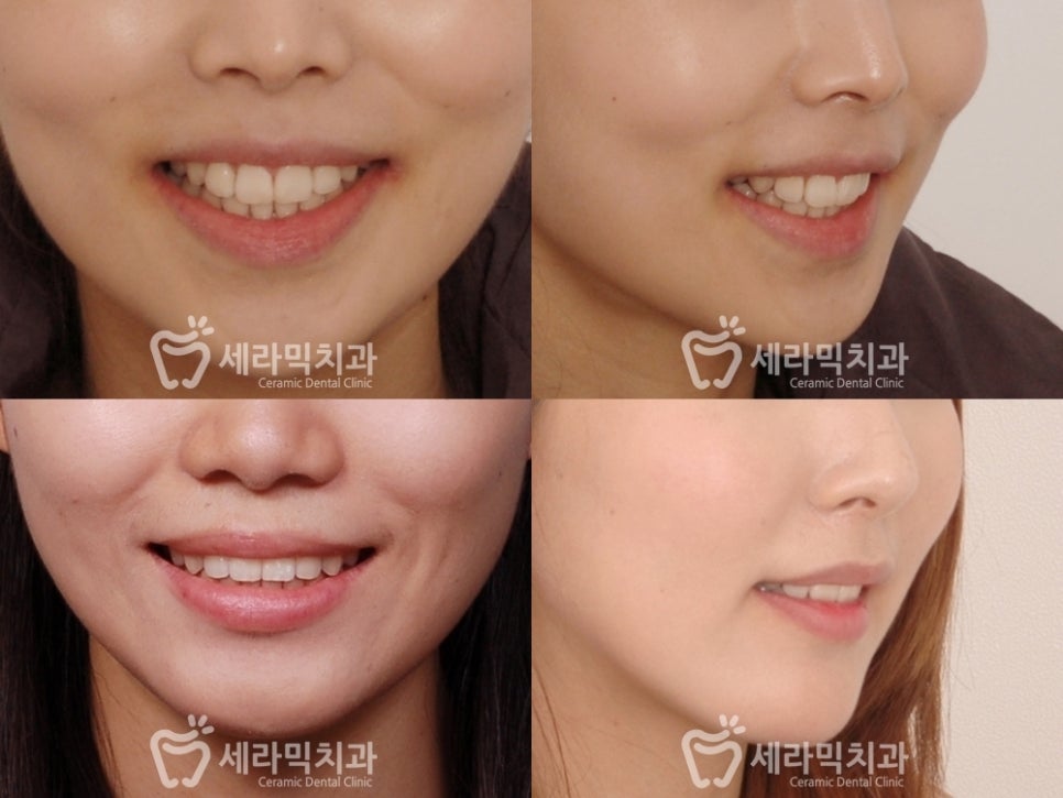 덧니 치아교정잘하는곳, 강남 세라믹치과 관련 이미지 6