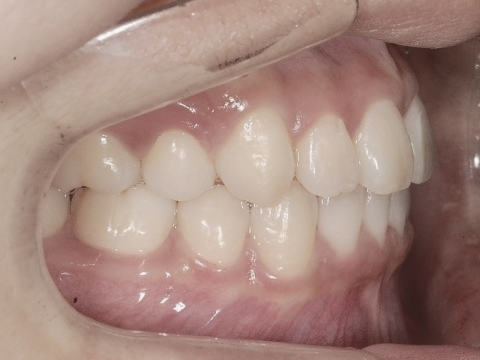 학동역치과 하면 세라믹교정 ~ 관련 이미지 22