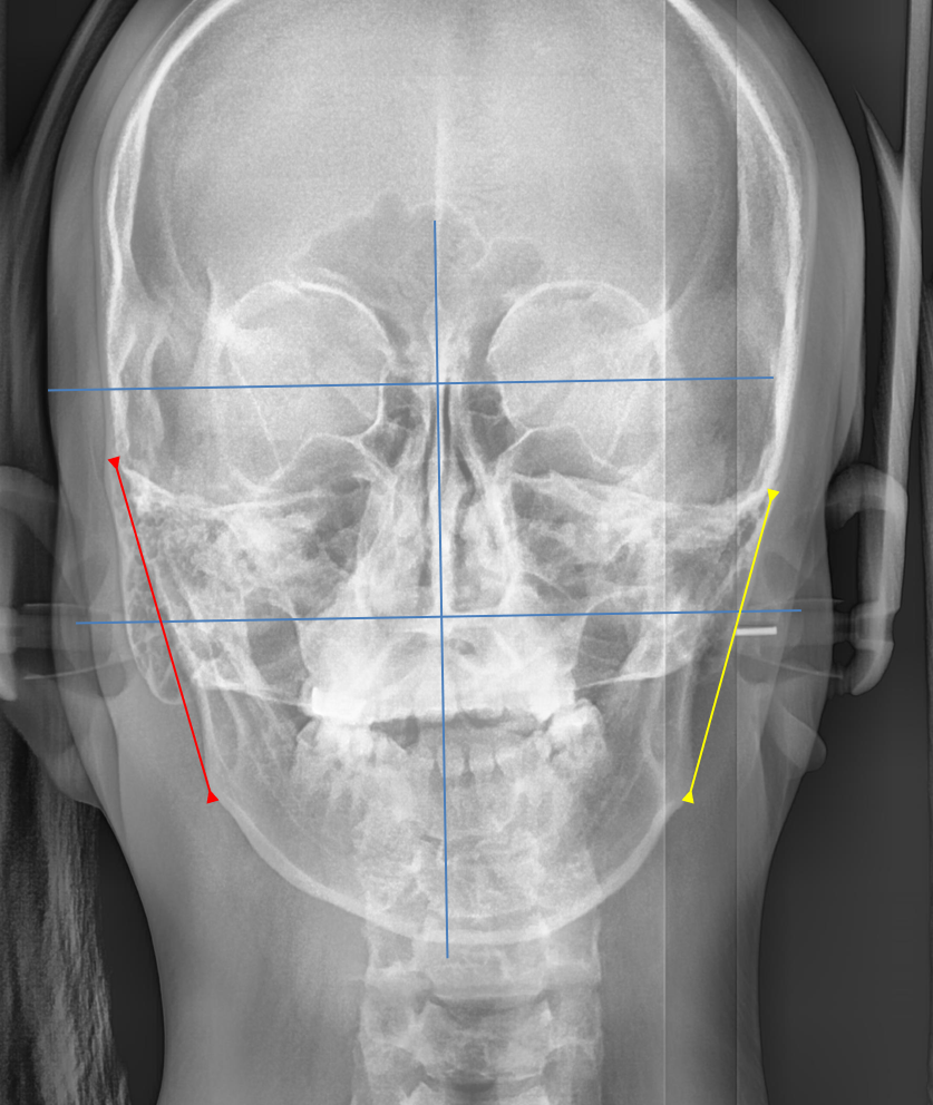 학동역 교정치과, 개방교합과 비대칭을 수술없이 교정한 경우 관련 이미지 6