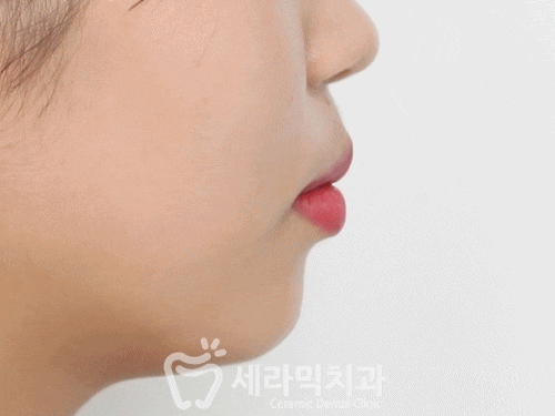 치아교정전후 사진영상. 돌출입교정하고 더 예뻐지자! 관련 이미지 1
