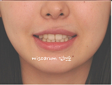 강남 돌출입 교정 관련 이미지 16