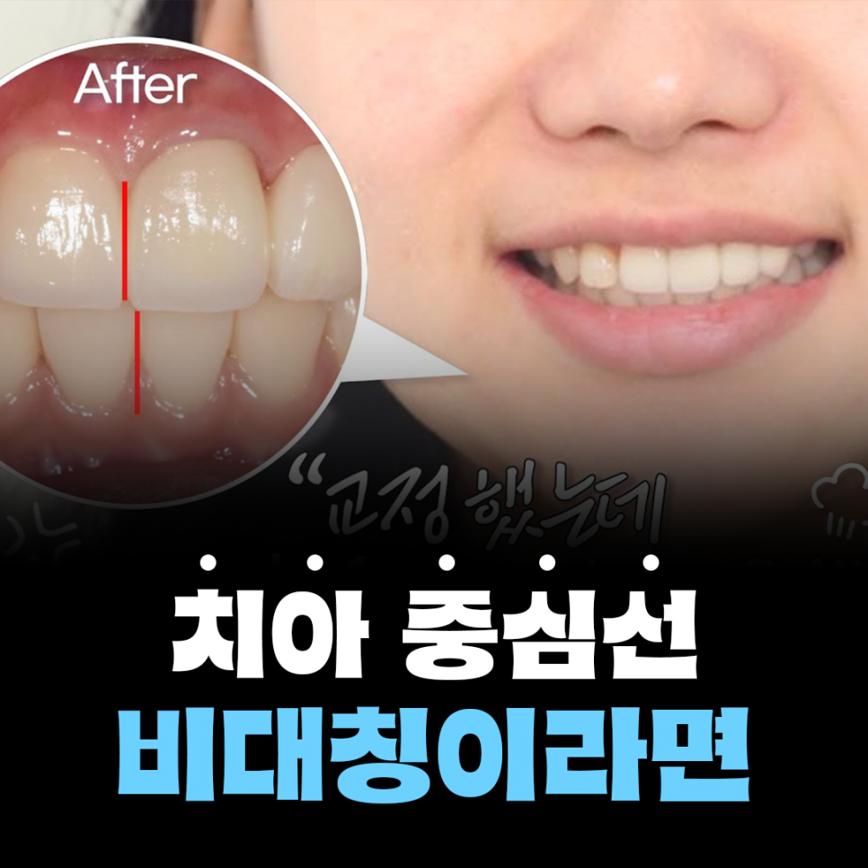 앞니 중심선 안맞으면, 안면비대칭인가요? [치아교정 필요한 예시] 관련 이미지 1