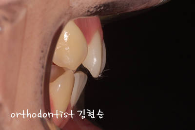 치열 교정(치열 불규칙) 관련 이미지 6