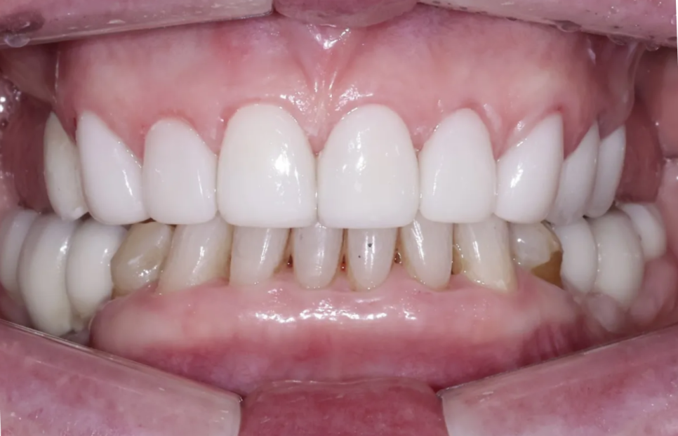 강남구청역 치과, 70대 외국인 환자의 라미네이트 관련 이미지 7