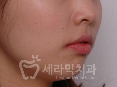 돌출입 덧니 비대칭 치아교정 전후 인상변화! 관련 이미지 6