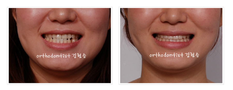 주걱턱수술 안하고 양악수술 안하고 관련 이미지 16