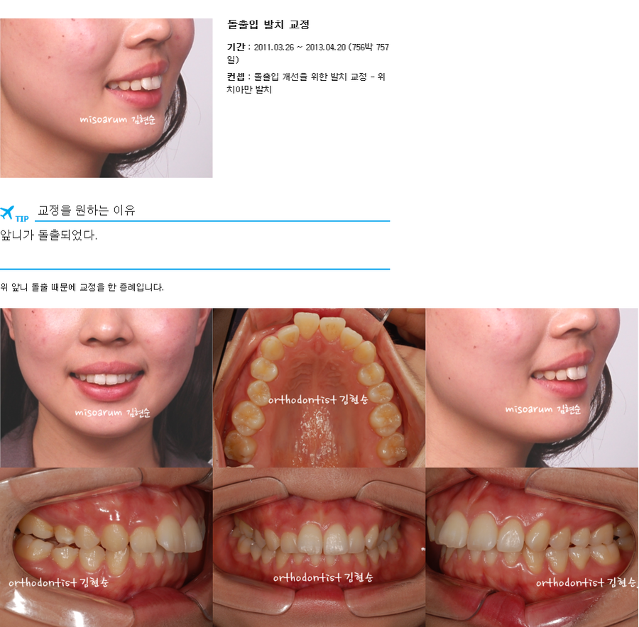 세라믹교정 세라믹치과-돌출입발치교정 2 관련 이미지 1