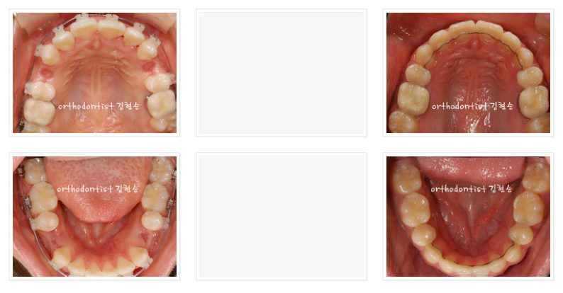 미니스크류를 이용한 발치 돌출입 교정, 무턱 개선 관련 이미지 8
