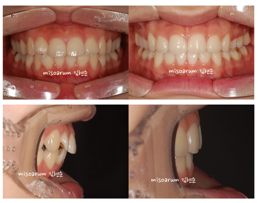 세라믹교정 세라믹치과-돌출입발치교정 9 관련 이미지 5