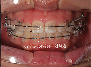 강남 돌출입 교정 관련 이미지 31