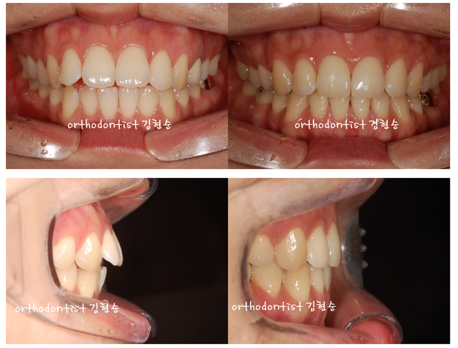 돌출입발치 교정증례 관련 이미지 6
